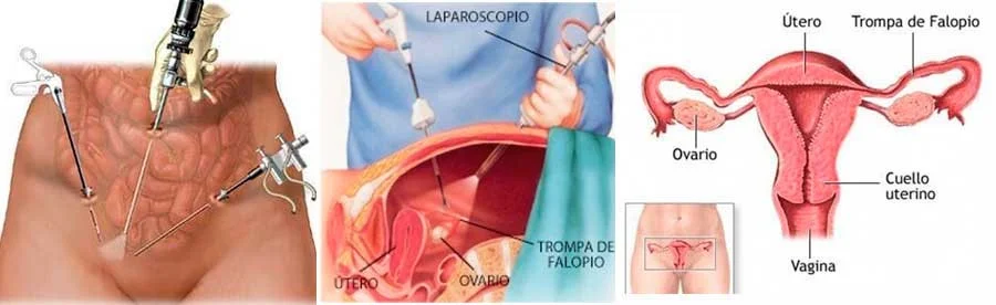 Cirugía Laparoscópica