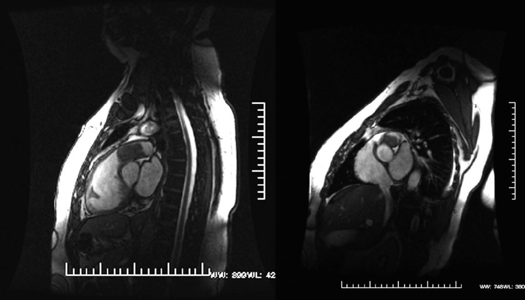 Sarcoma Pulmonar